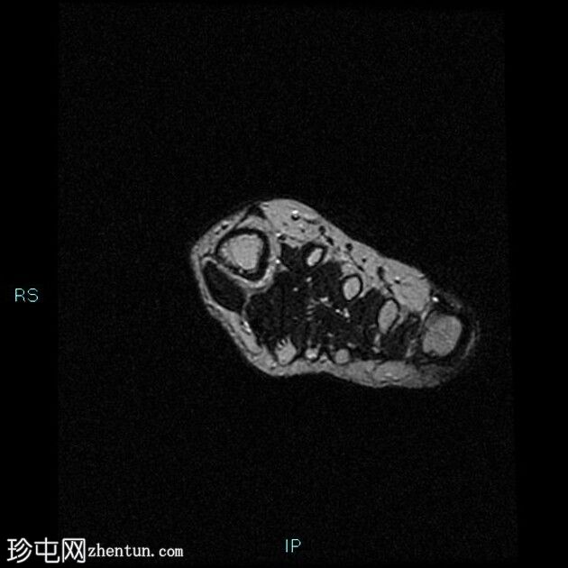 奇怪的骨旁骨软骨瘤增生（Nora 病变）