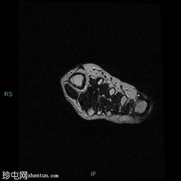 奇怪的骨旁骨软骨瘤增生（Nora 病变）