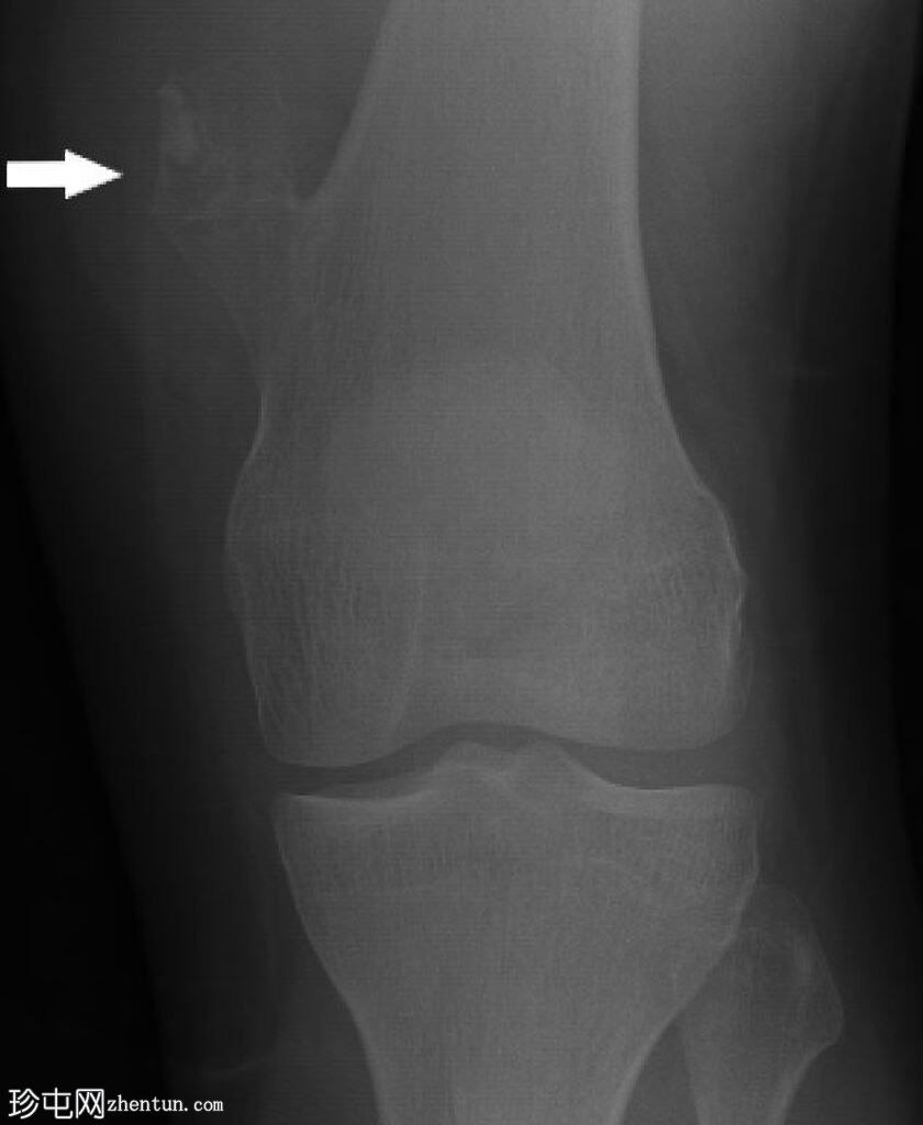 骨软骨瘤 - 股骨