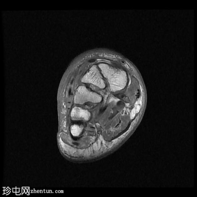 糖尿病足骨髓炎