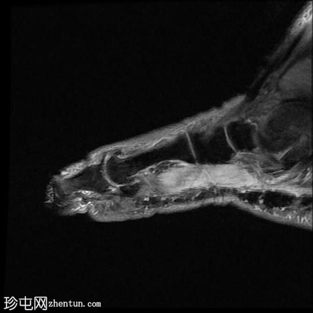 糖尿病足骨髓炎