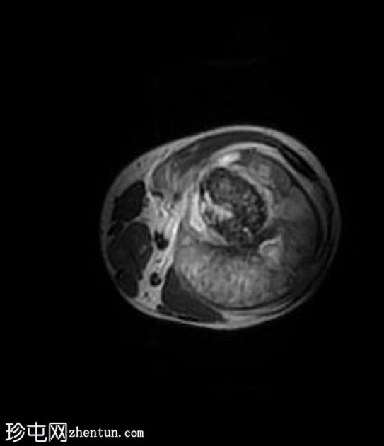 软骨母细胞性骨肉瘤