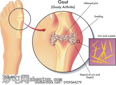 高尿酸血症