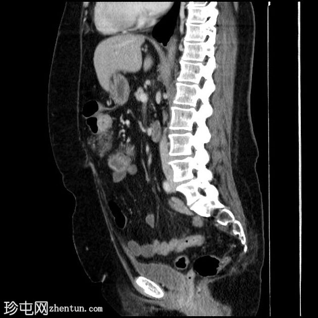 大网膜局灶性梗死