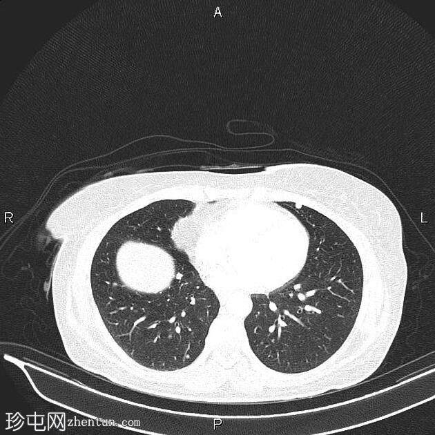 转移性和阻塞性乙状结肠腺癌