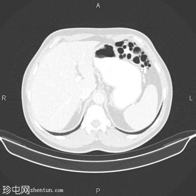 结肠积氧症