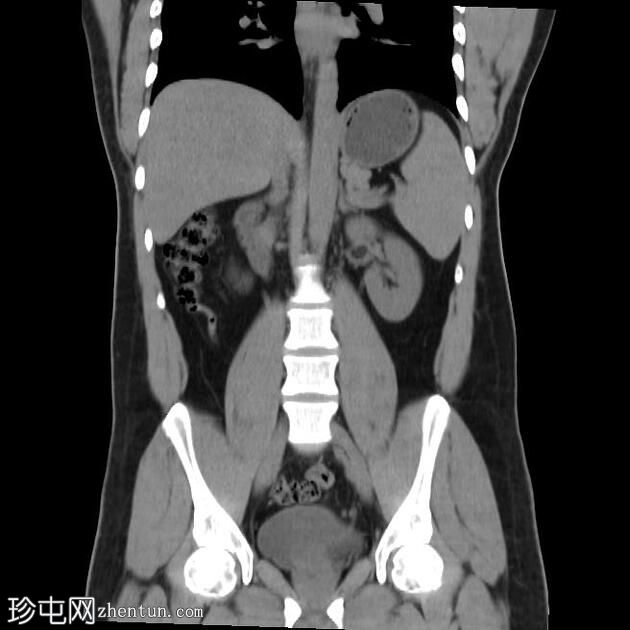 肠脂垂炎