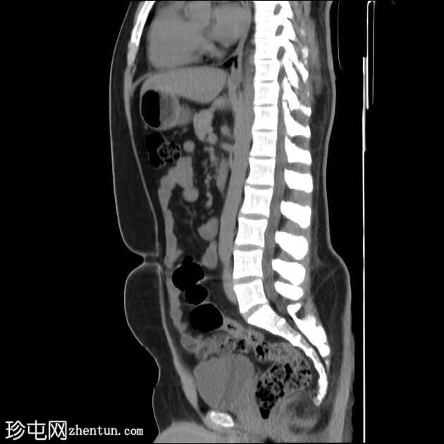 肠脂垂炎