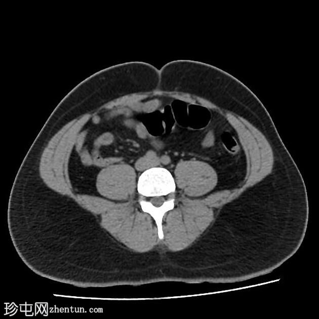 肠脂垂炎