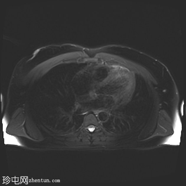 IV型变异胆管解剖与胆石症、胆囊炎和扩张的右侧胆管根