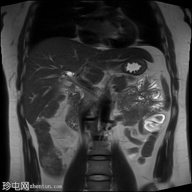 IV型变异胆管解剖与胆石症、胆囊炎和扩张的右侧胆管根