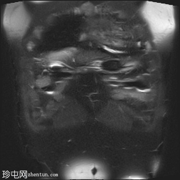 IV型变异胆管解剖与胆石症、胆囊炎和扩张的右侧胆管根