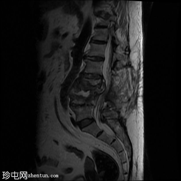 脊椎间盘炎 - 术后