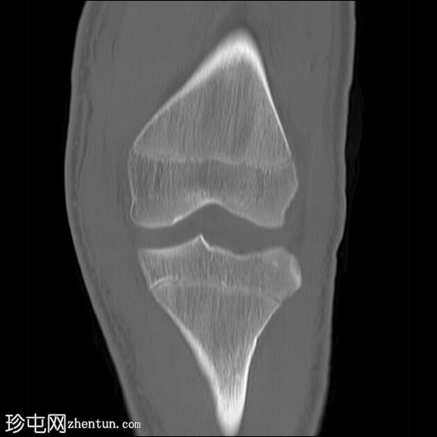 胫骨近端骨折 - Salter-Harris III 型