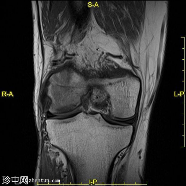 膝关节软骨下功能不全骨折