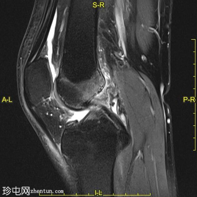 膝关节软骨下功能不全骨折