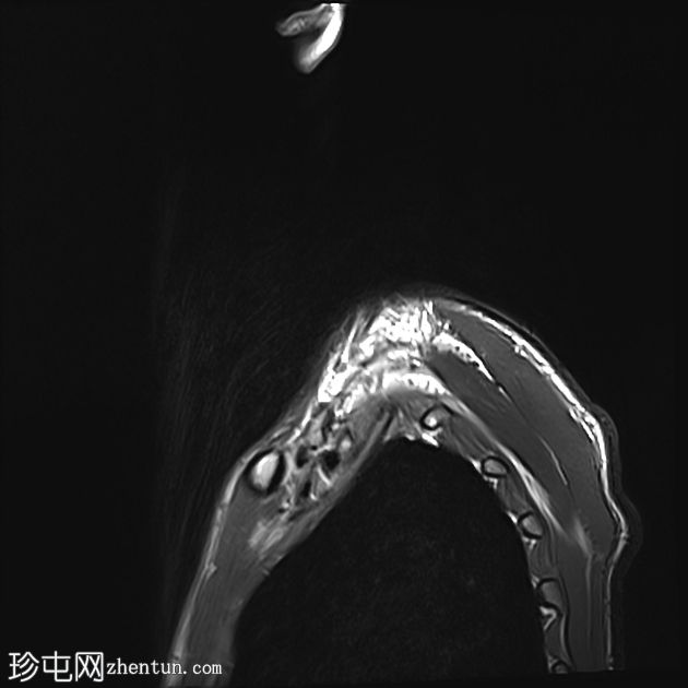 臂丛神经完全断裂