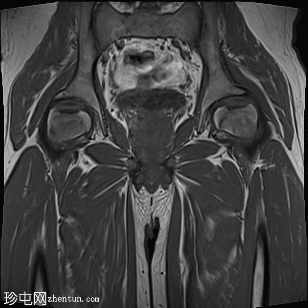 股骨头缺血性坏死