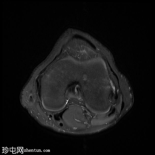 局灶性骺膜水肿区