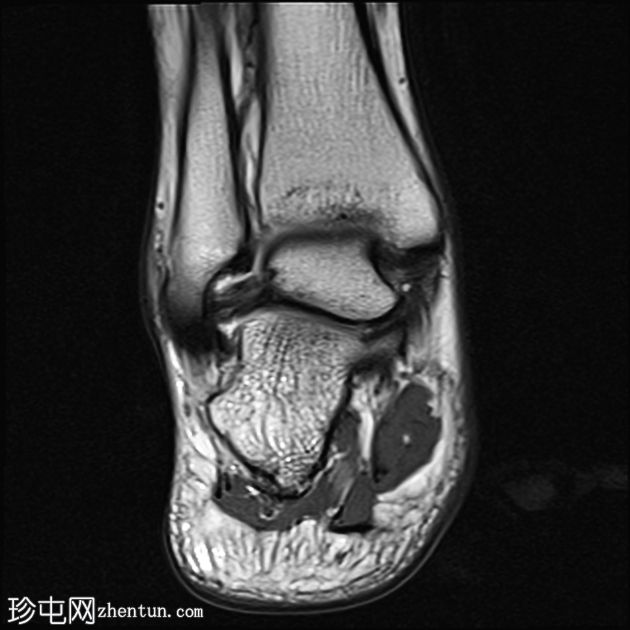 前距腓韧带完全撕裂