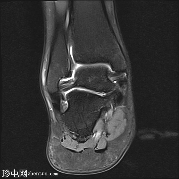 前距腓韧带完全撕裂