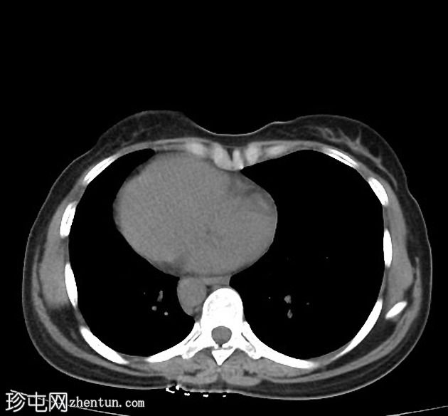 完全性内脏反位（Situs inversus totalis，SIT）