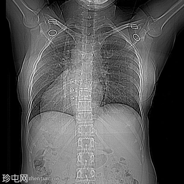 完全性内脏反位（Situs inversus totalis，SIT）