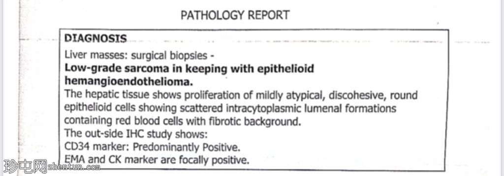 肝上皮样血管内皮瘤