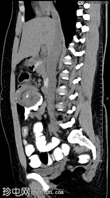 结肠粘液癌引起的结肠肠套叠