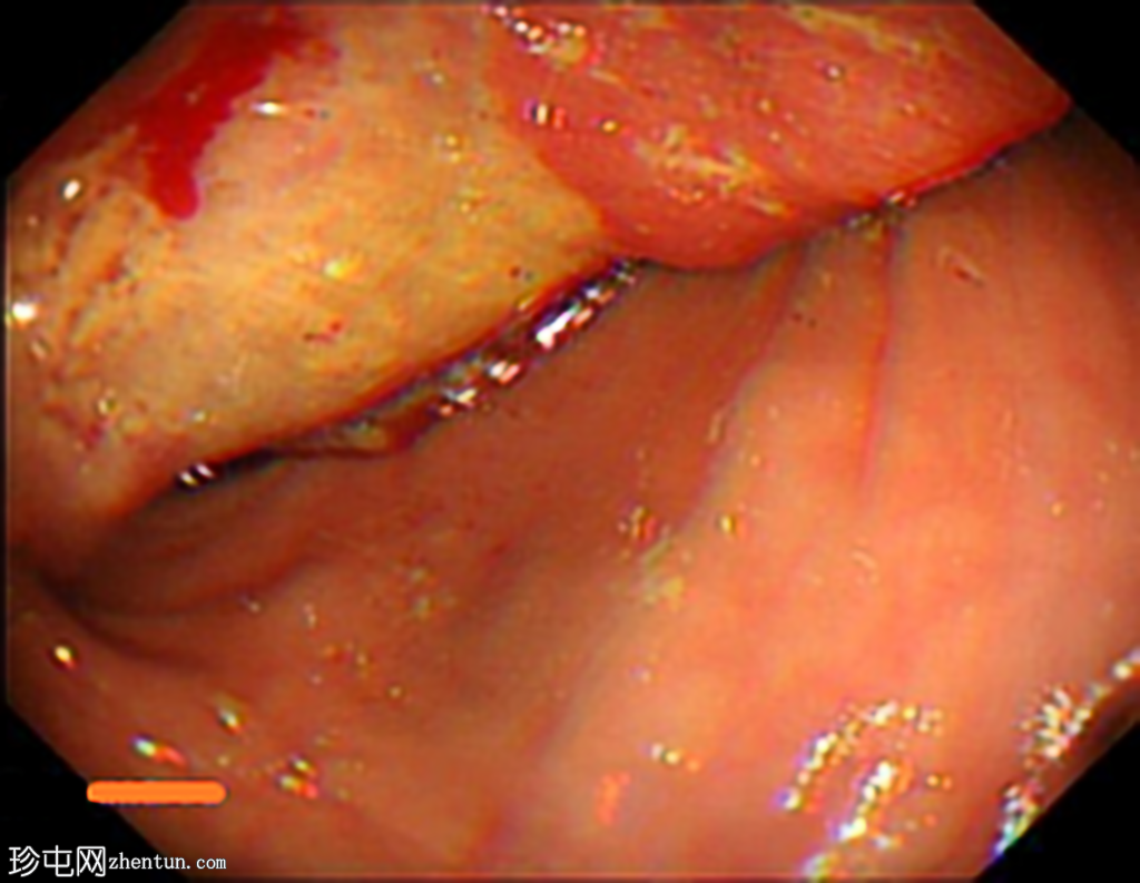 结肠粘液癌引起的结肠肠套叠