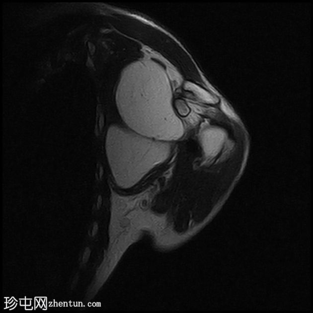 腋窝脂肪瘤