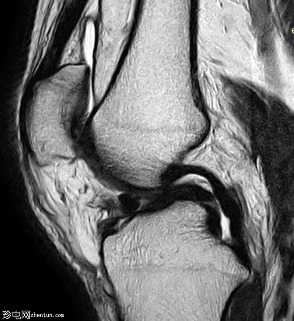 内侧半月板桶柄撕裂