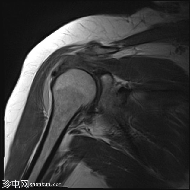 冈上肌腱钙化性肌腱炎