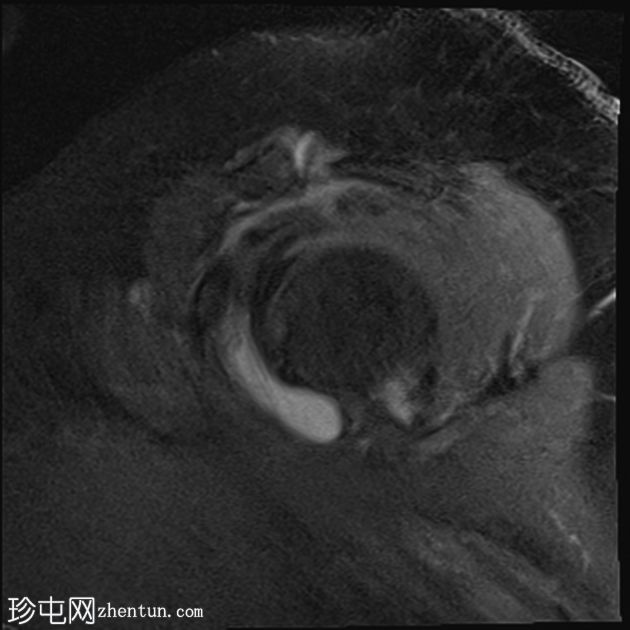 冈上肌腱钙化性肌腱炎