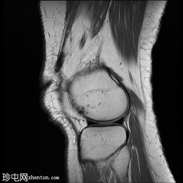 骨样骨瘤伴非骨化纤维瘤