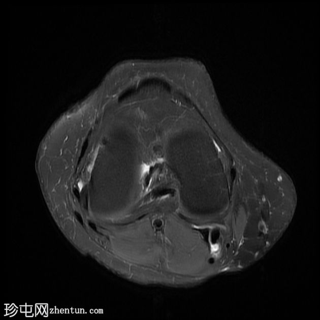 骨样骨瘤伴非骨化纤维瘤