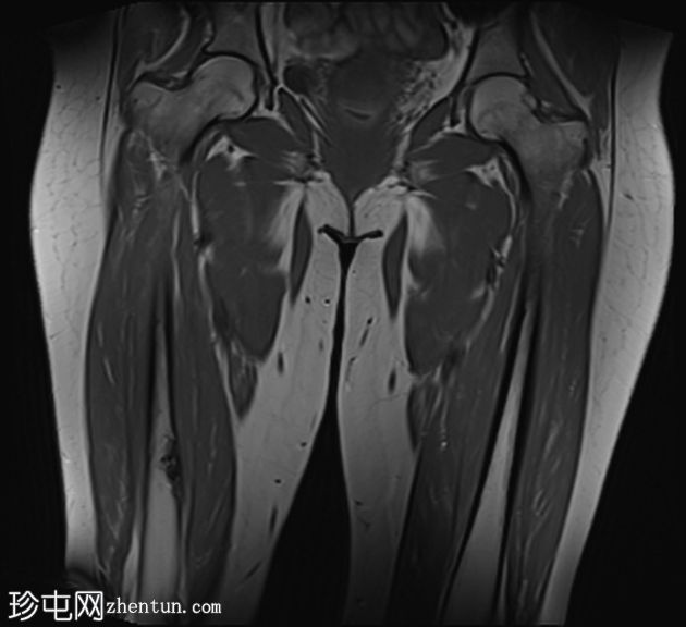 骨样骨瘤伴非骨化纤维瘤