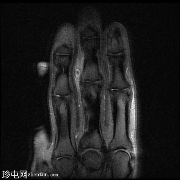 手中的木质异物