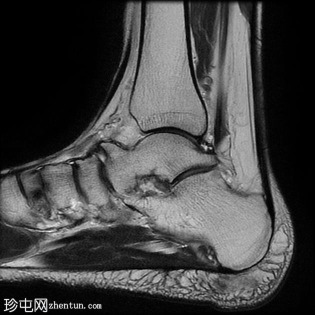 距跟骨纤维联合