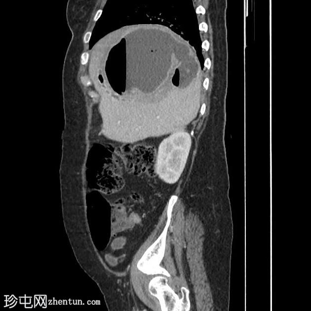 肝脓肿破裂进入胆道，并伴有胆管炎和右肝静脉血栓形成