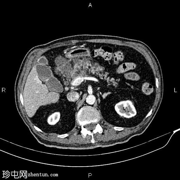 急性坏死性胰腺炎