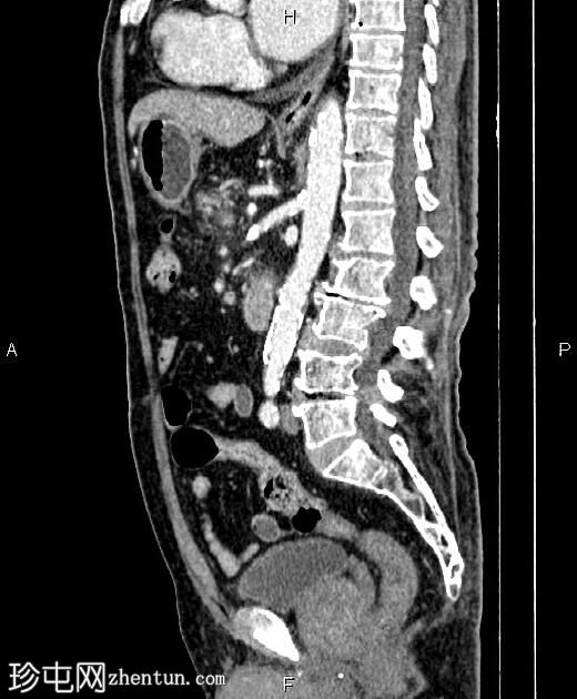 急性坏死性胰腺炎