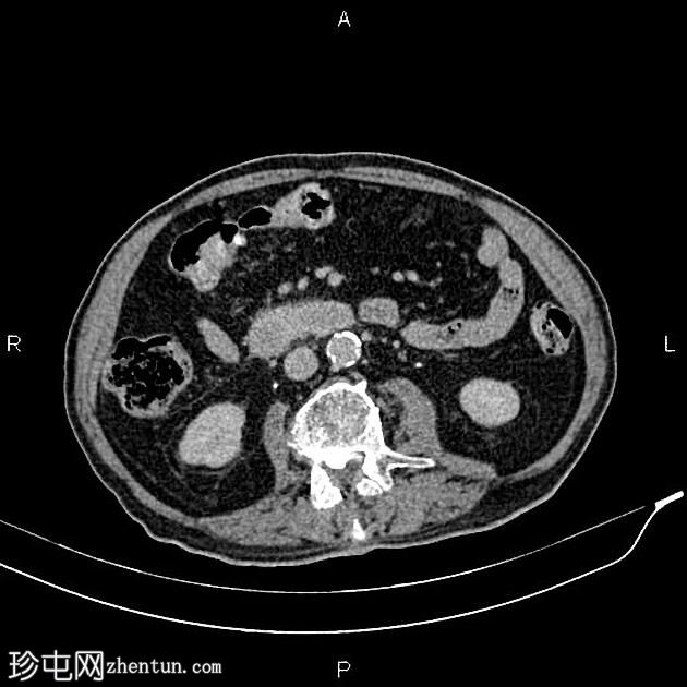 急性坏死性胰腺炎