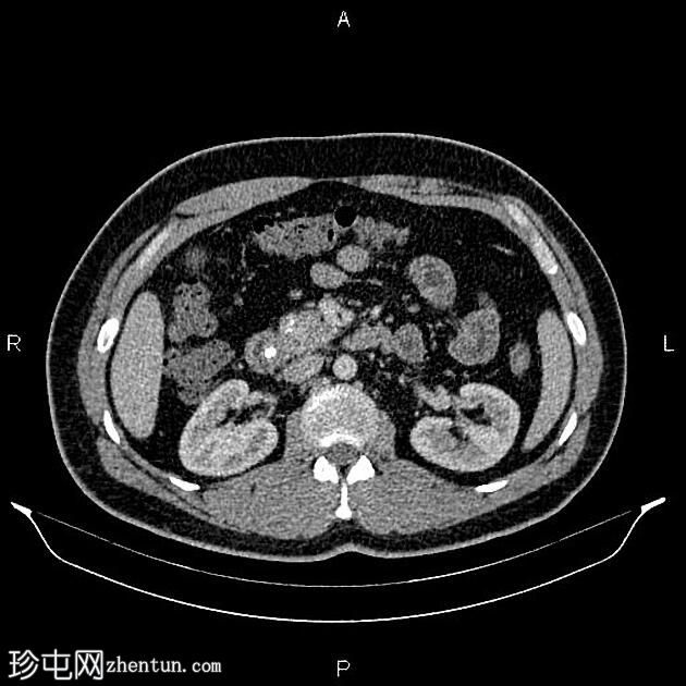 慢性胰腺炎