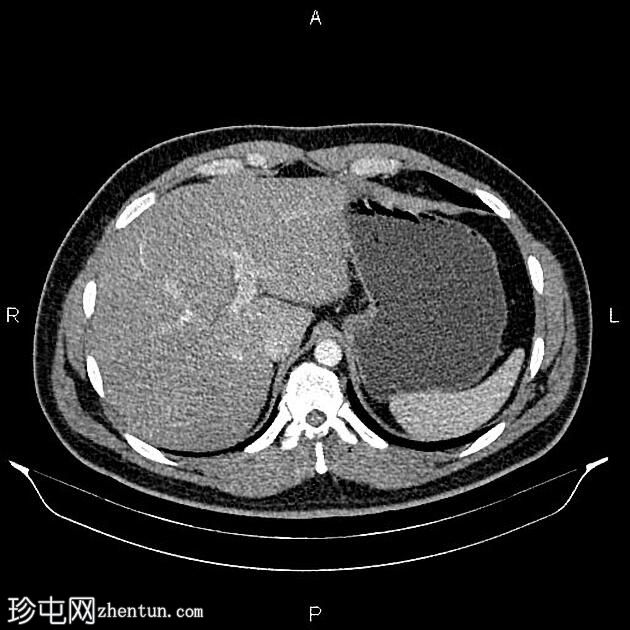 慢性胰腺炎