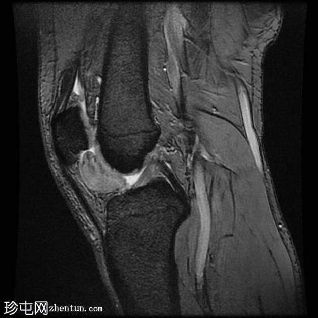 囊内软骨瘤 - 膝盖