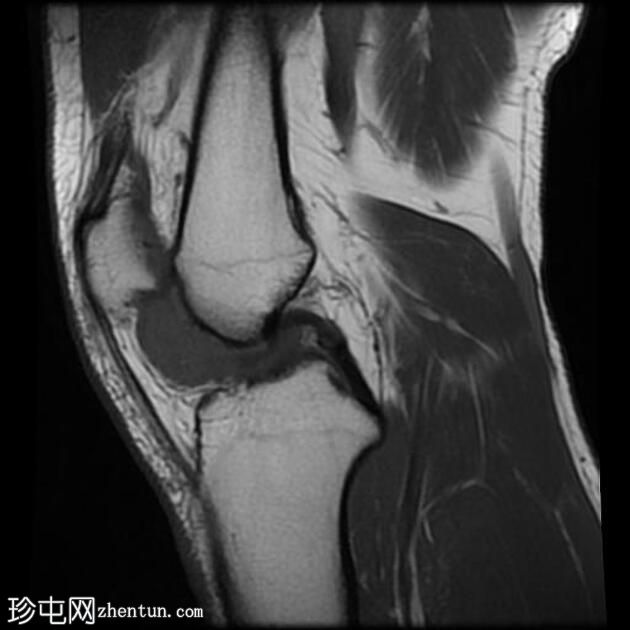 囊内软骨瘤 - 膝盖