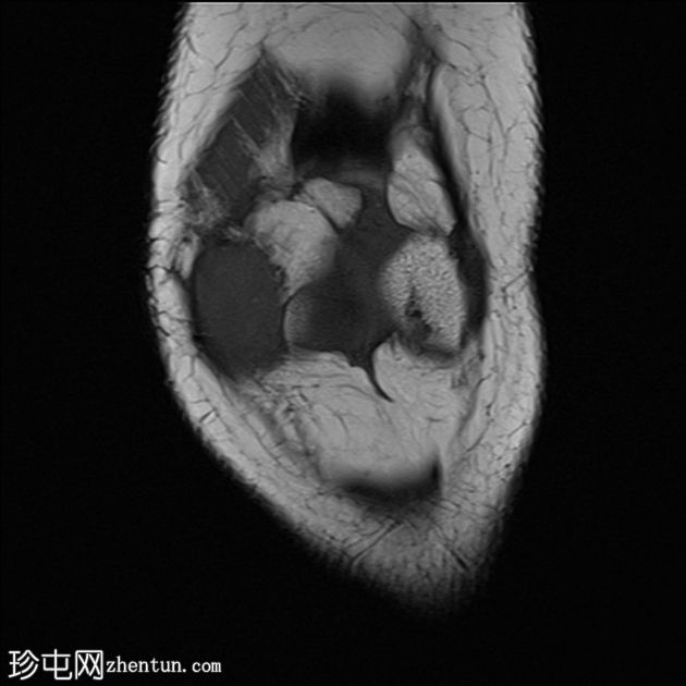 滑膜血管瘤