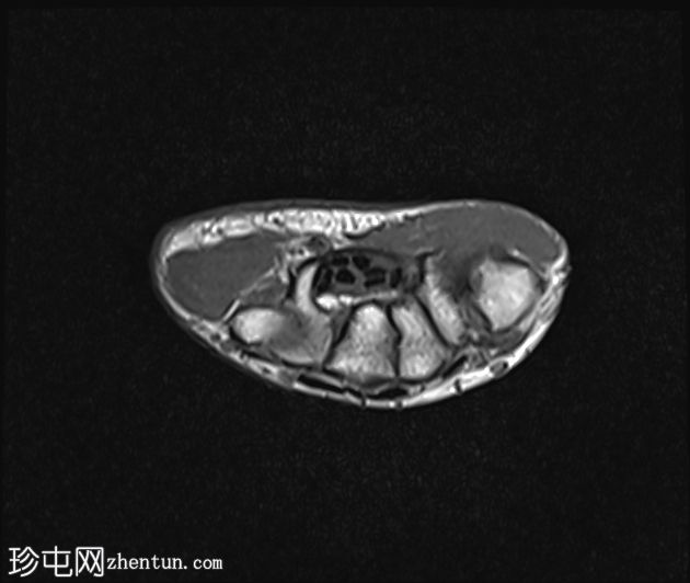 大多角骨掌骨关节炎