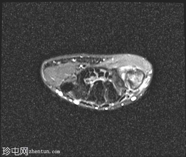 大多角骨掌骨关节炎